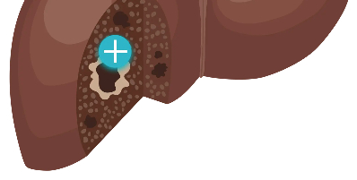 Illustration of a liver with liver cancer