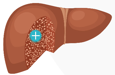 Illustration of a liver with fibrosis