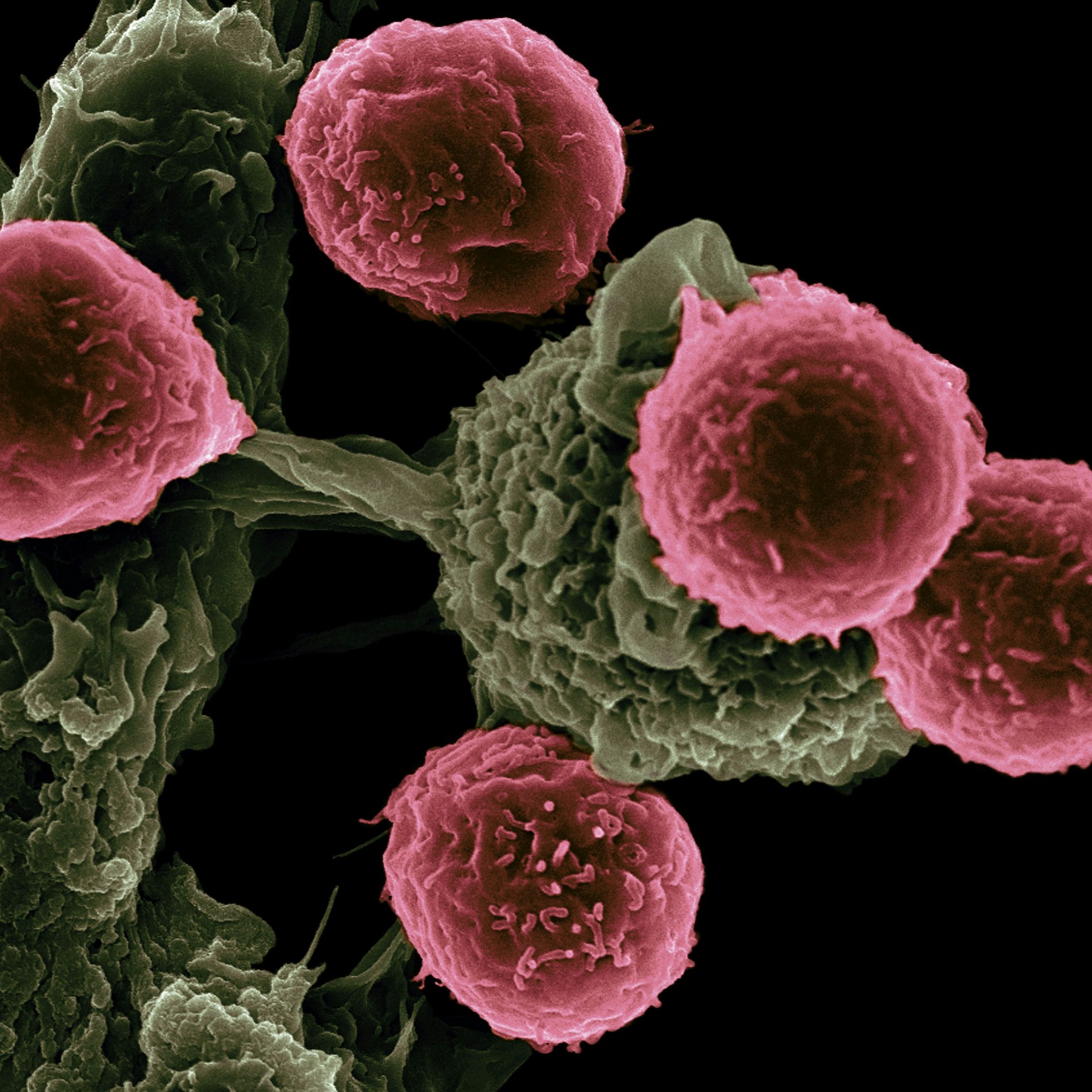 Scanning electron micrograph of cancer cells