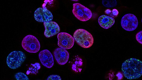 MedPage Today: Helio Featured in Liver Cancer Blood Test Roundup
